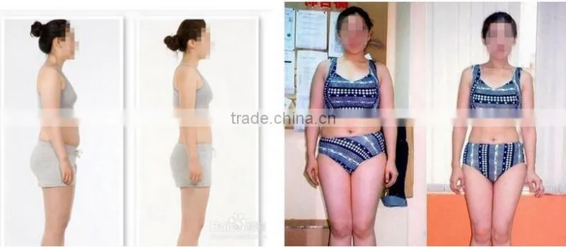 AYJ-S10(CE) liposonic slimming machine / liposunic device for reduce fat