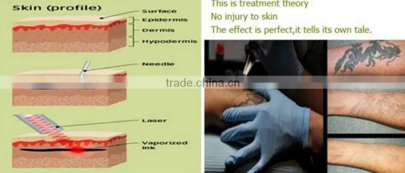 K10 Laser Type Tattoo Removal/Pigment Removal Feature tattoo laser machine