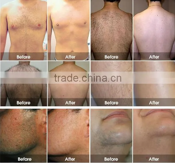 opt with ipl shr faster hair removal in motion than 808nm diode laser