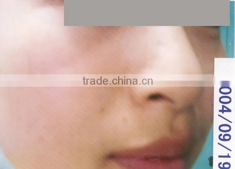acne removal beauty device elight beauty beauty salon devices
