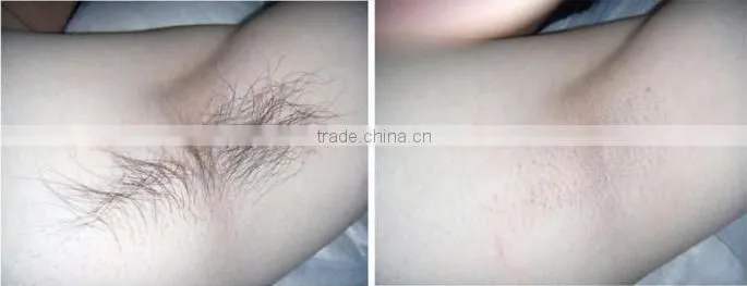 Advanced cooling system painless permanent laser shr IPL hair removal machine