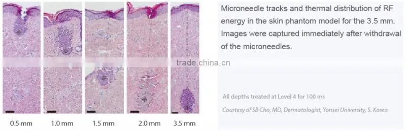 Top quality! CE/FDA approved rf fractional equipment