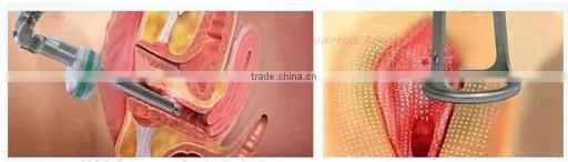 RF tube co2 fractional laser
