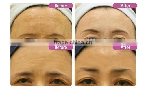Dermaroller 540 needles injectable collagen photon microneedle therapy L001