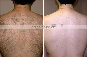 Portable mini laser hair removal machine for home use -P003