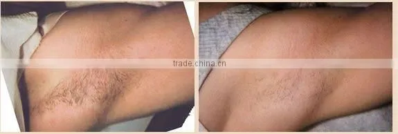 Portable IPL Machine(Huamei)