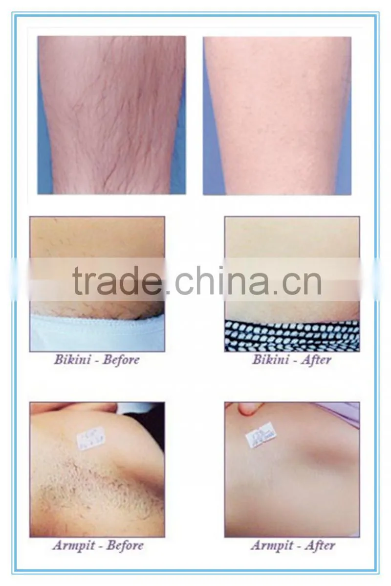 lightsheer laser hair removal machine for sale
