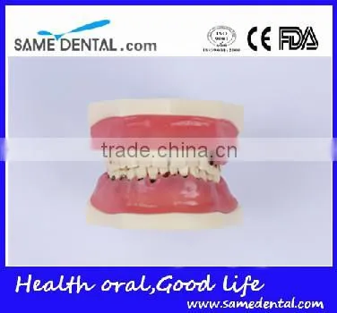 Dental Severe Periodontal Disease Model School Teaching