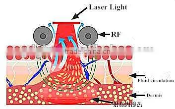 Laser Cavitation RF Vacuum Slimming Machine/B-015A