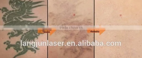 q switch laser tattoo removal machine for skin tattoo treatment