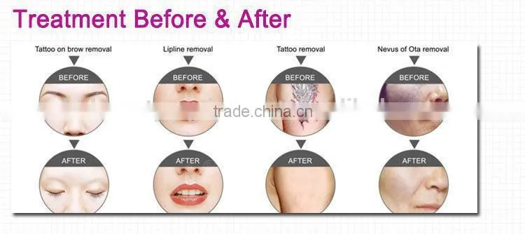 skin care beauty machine for remover tattoo with tattoo removal cream