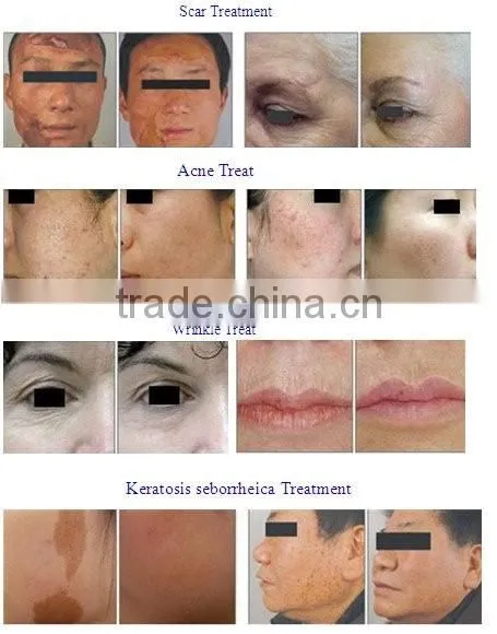 Fractional Co2 laser for skin rejuvenation, Co2 fractional laser machine scars removal & acne treatment
