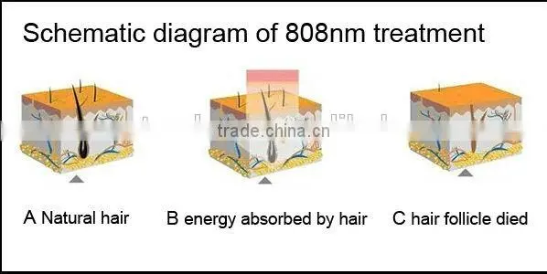 laser hair removal machine 808nm diode laser with 10 laser bars