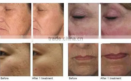 fractional CO2 medical laser low price