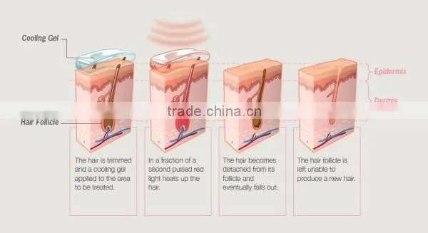 Effective intense pulse light table top ipl hair removal machine