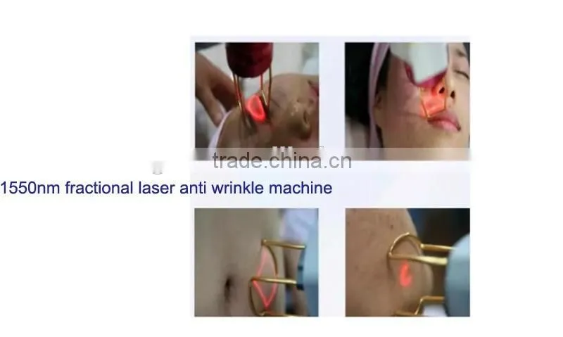 1550nm Anti-Aging Laser Stretch Marks Elimination Rejuvenation Therapy Machine 1550nm laser fiber laser machine