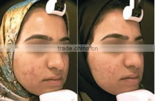 Chinese IPL hair removal from HUAMEI HM-IPL-B1