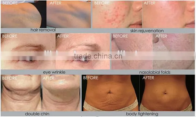 permanent hair removal treatment