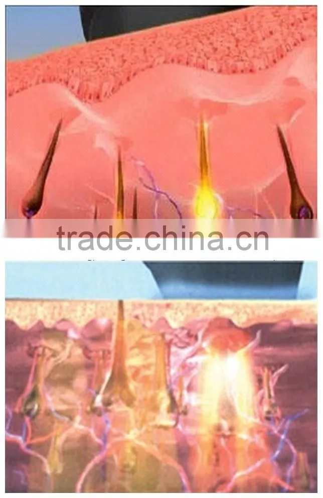 Pain Free 808nm Laser Diode Epil Unwanted Hair Removal Laster Treatment Laser Depilator