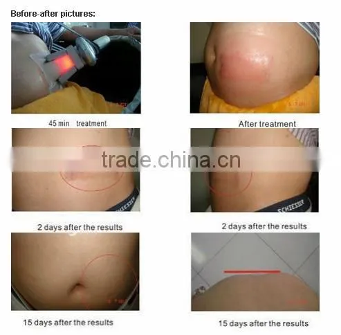 Fat Cavitation Device For Home/Weight Loss Machine/RF--Pro Cryolipo