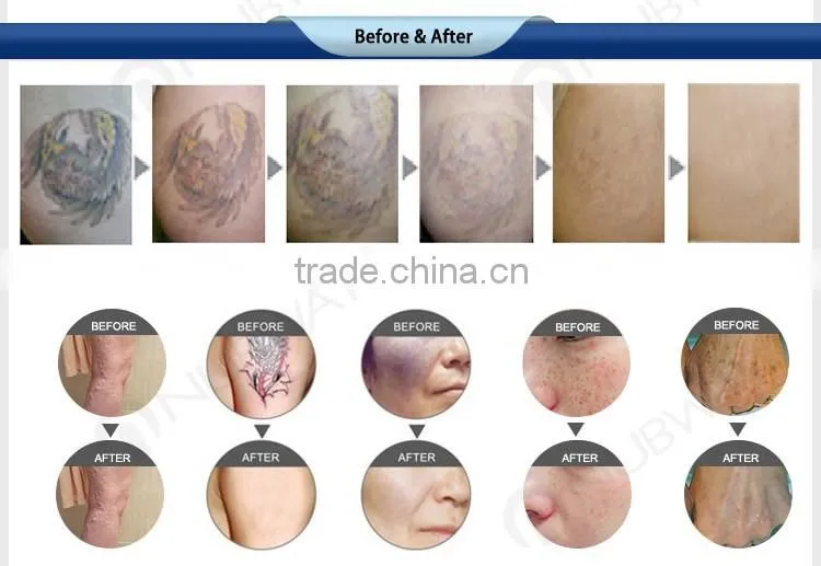 2016 varicose veins laser treatment pigments tattoo removal nd yag laser machine prices