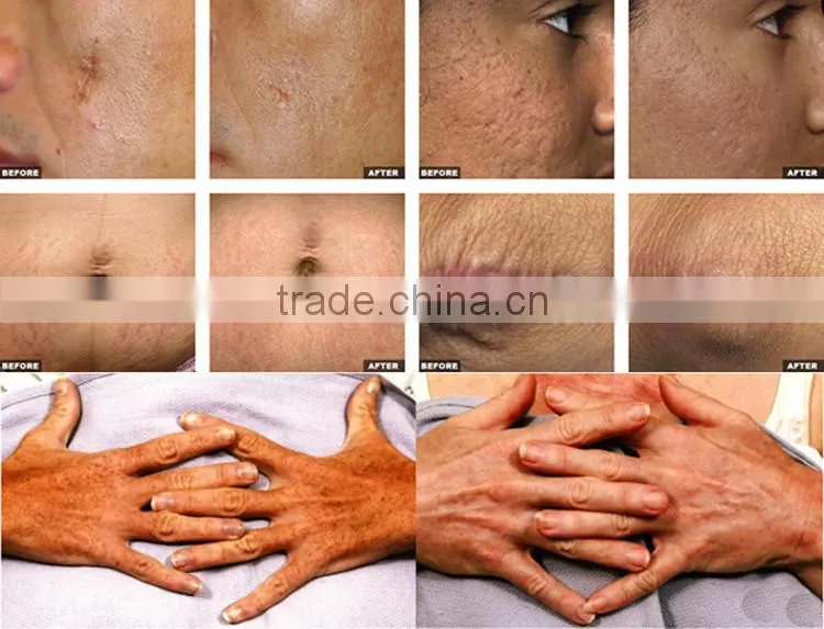 Professional 2017 newest 1-100ms pulse duration 30w fractional co2 laser treatment for acne scars
