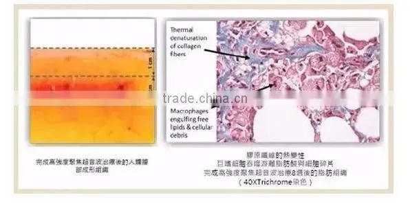 weight loss non-invasive skin tightening liposonix machine