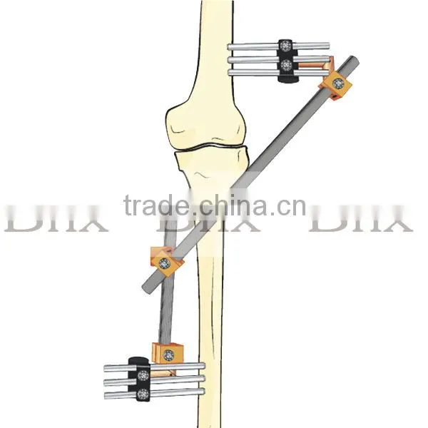 CE Certificate External Fixator