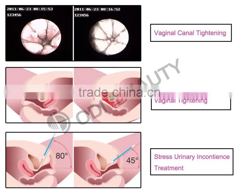 OD-V8 Professional fractional co2 laser treatment with beautiful vaginas
