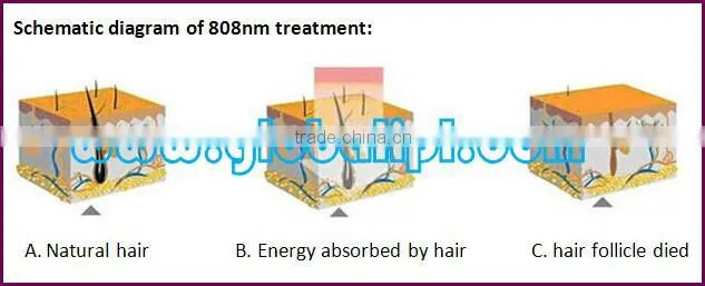 New technology vascular therapy IPL diode laser facial hair remove