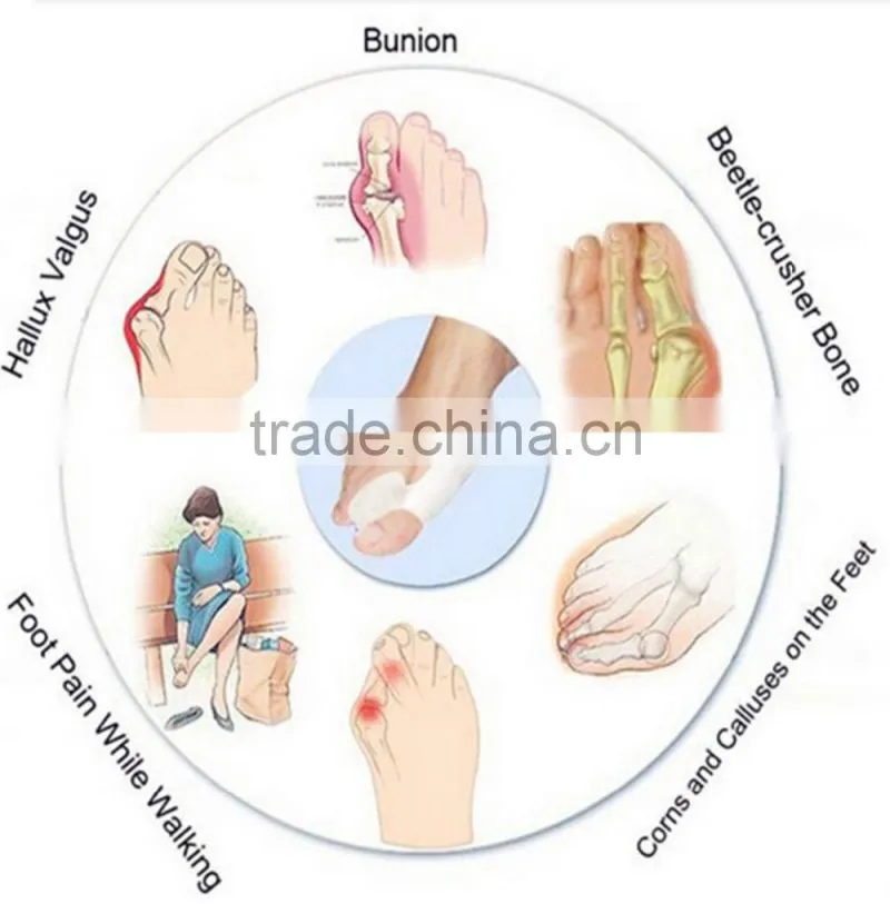 2016 Shuoyang Hot wholesale foot care toe separator bunion protector