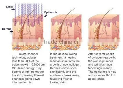 fractional CO2 medical laser low price