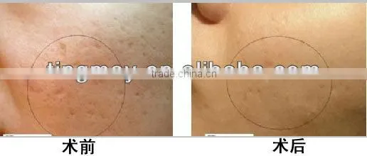 Microneedle Skin Roller Skin Massage Roller