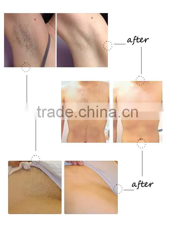 Russia sell like hot cakes!!!!! Diode laser/808nm diode laser hair removal/CE