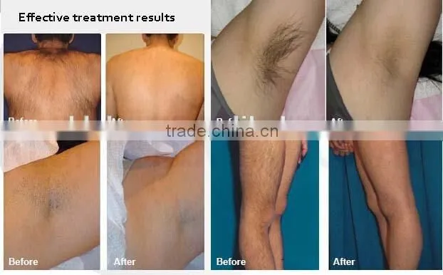 China Diode Laser Hair Removal 808nm Laser (808)
