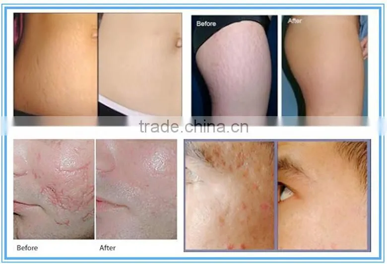medical equipments co2 laser for acne scar removal
