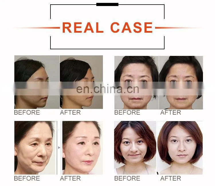 portable wrinkle remover skin tightening face lift anti aging slimming machine