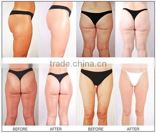 Hot!Suslaser Fast Radio Frequency System Cavitation Cellulite Slimming System For Home Use