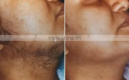 2016 Personal use 1064 long pulsed nd yag laser hair removal machine