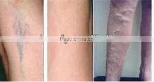 laser hair removal machine 1064nm long pulse laser machine leg /facial veins removal P003
