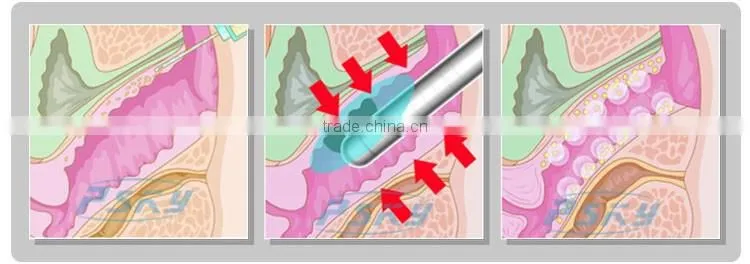 10000 shots woman painless vaginal rejuvenation HIFU machine for sale