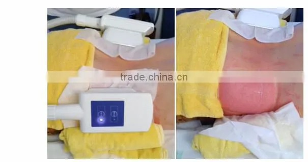 Cryotherapy body vacuum cupping massage machine