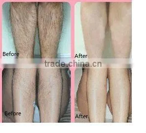 high frequency treatment for hair loss machine