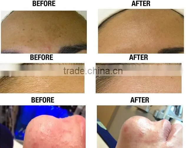 Home use oxygen therapy skin facial treatment oxygen spary gun nutrition import