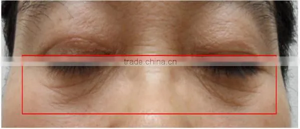 Hot!!! New products,portable home hifu anti-wrinkle machine /hifu machine home