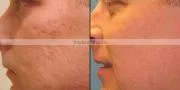Newest !!! luxury fractional co2 laser acne scar removal