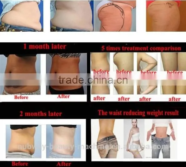 Cavitation Slimming Machine with Tripollar RF, ultrasonic cavitation, monopolar RF and vaccum handle