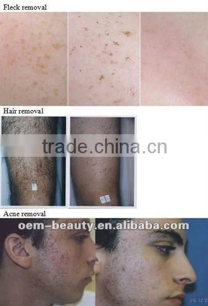 2012 Best IPL beauty machine for skin tightening and hair removal