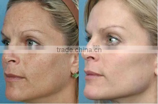 Professional ipl machine with reasonable ipl laser hair removal machine price
