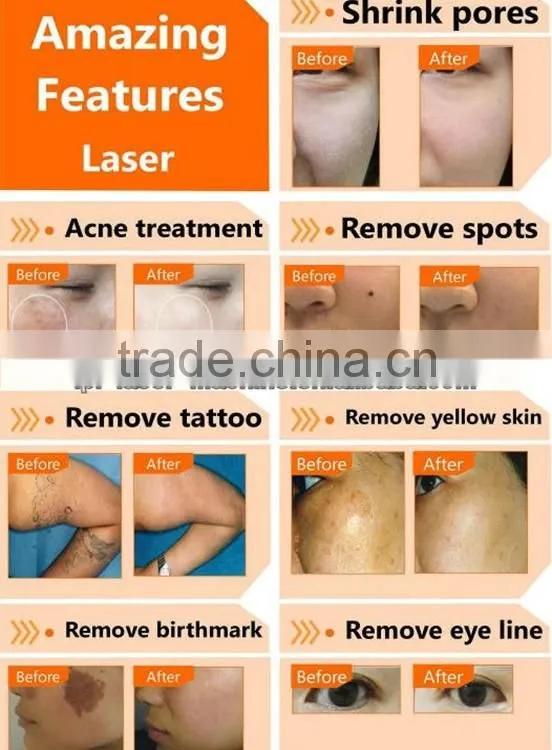 Q-switched Nd Yag Laser Mole Removal Machine/ Nd Yag Laser/Laser Tattoo Removal Machine